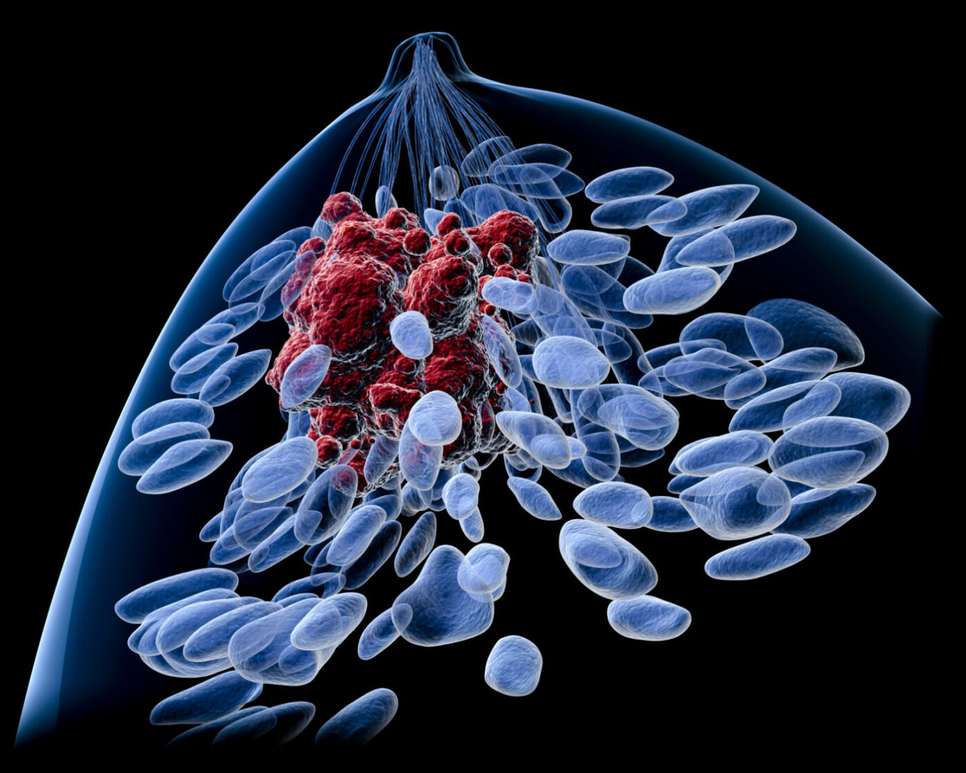 breast-cancer-metastases-supported-by-bone-microenvironment-genetic