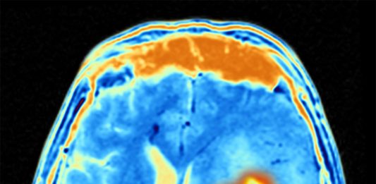 Brain tumour, illustration