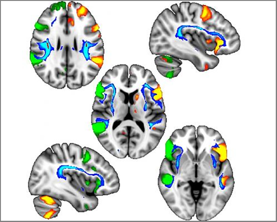 Genetic Variants Link Left Handedness With Brain Architecture And Psychiatric Disorders