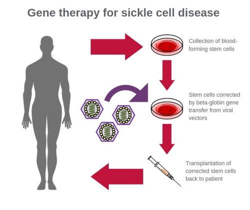 Gene Therapy Vehicle For Sickle-Cell Disease Shifts Forward