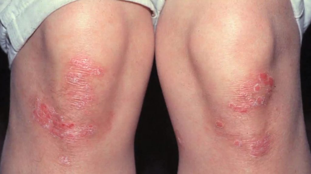 Psoriasis May Be Prevented by Targeting VEGFA Signaling in the Epidermis