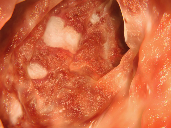 Ulcerative colitis