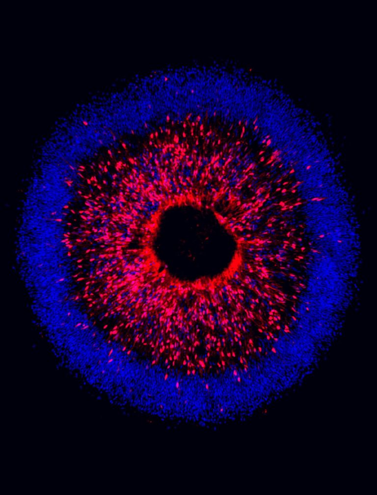 Human Stem Cell Model and CRISPR Used to Identify Degeneration in Glaucoma