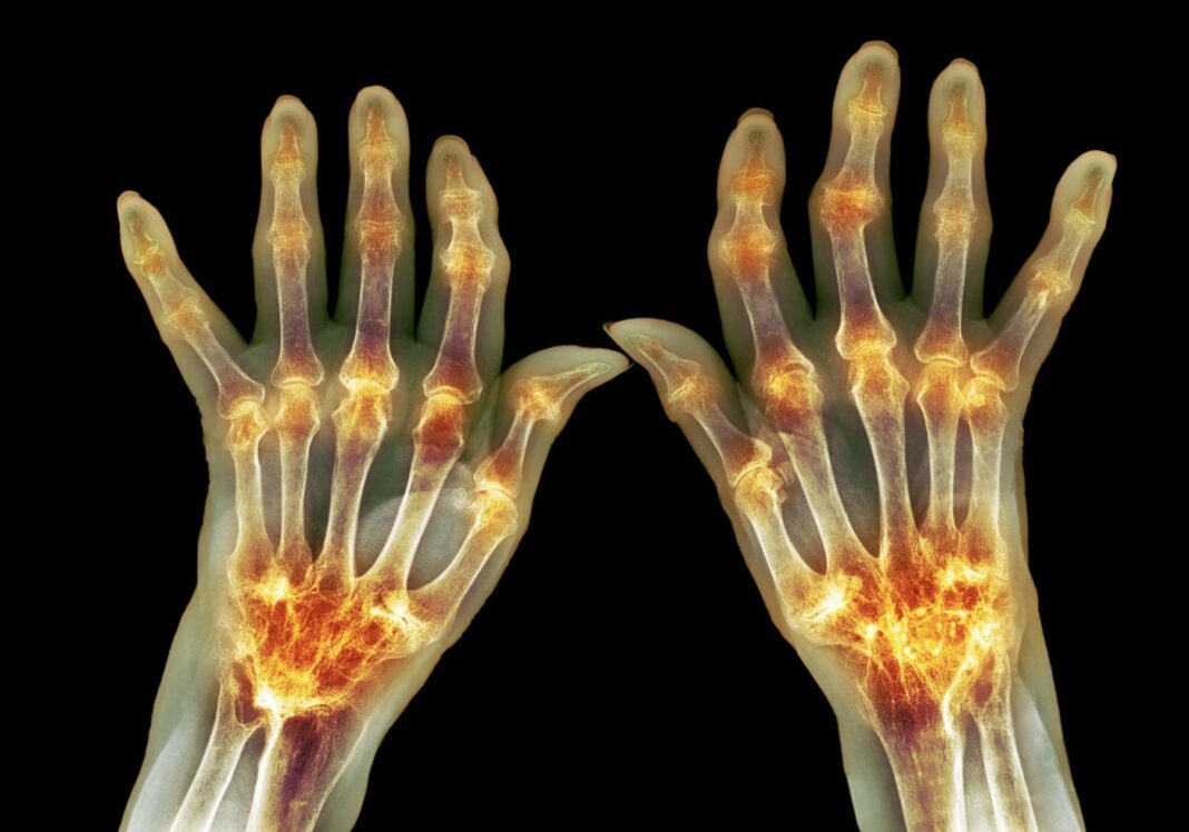 Rheumatoid arthritis, X-ray hands