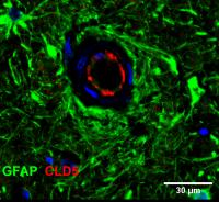 Immunohistochemistry of leukoencephalopathy patient