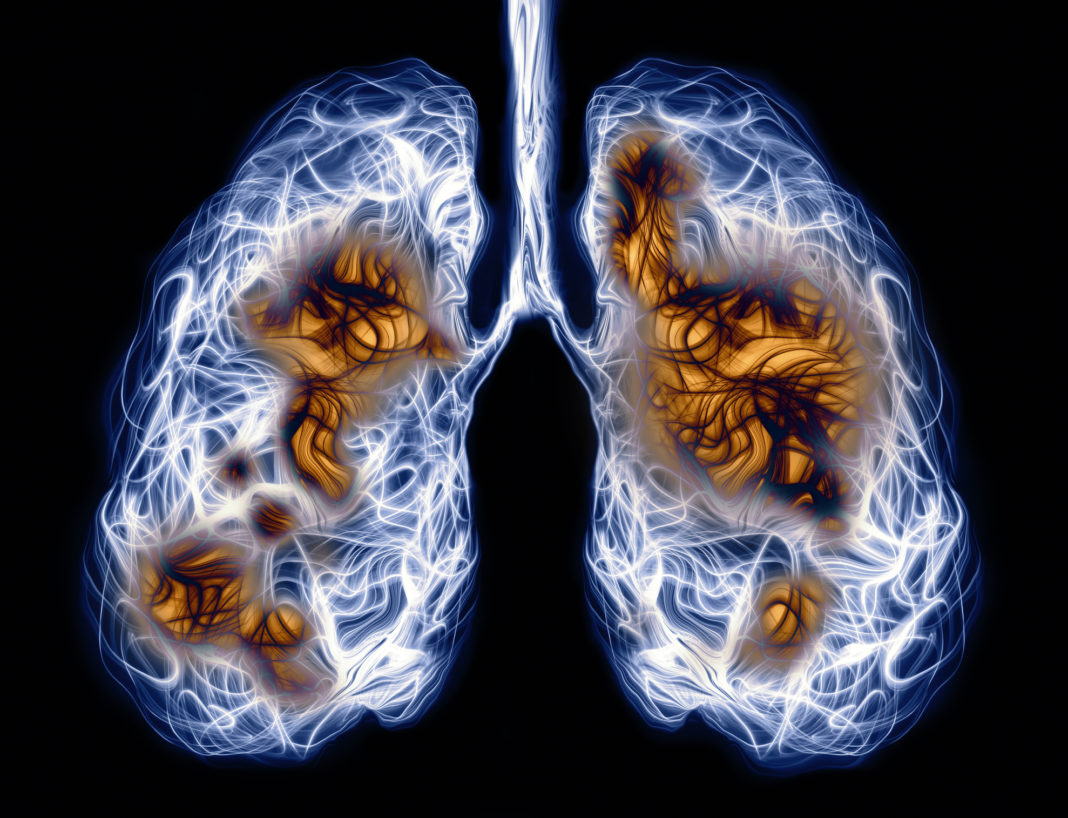 Infection in lungs