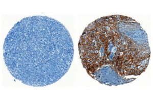 ENPP1 is a new therapeutic target for cancer
