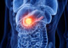 Pancreatic Cancer Drug That Blocks Ketogenic Pathway Reinforced by Ketogenic Diet in Mice