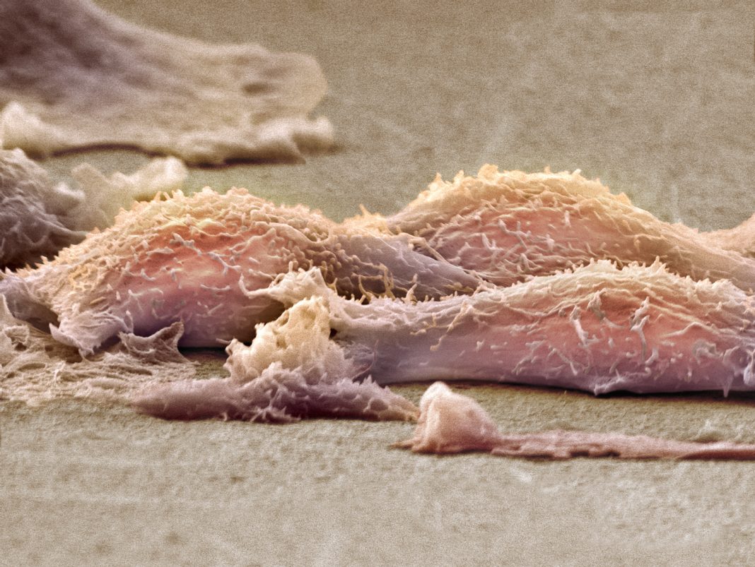 Sarcoma cells