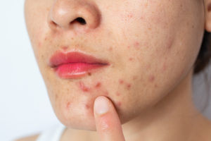 Close-up of woman half face with problems of acne inflammation (Papule and Pustule) and scar occur on her face.