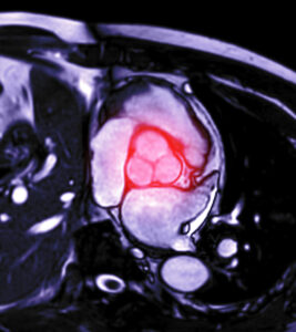 MRI heart or Cardiac MRI ( magnetic resonance imaging ) of heart showing aortic valve for diagnosis heart disease.