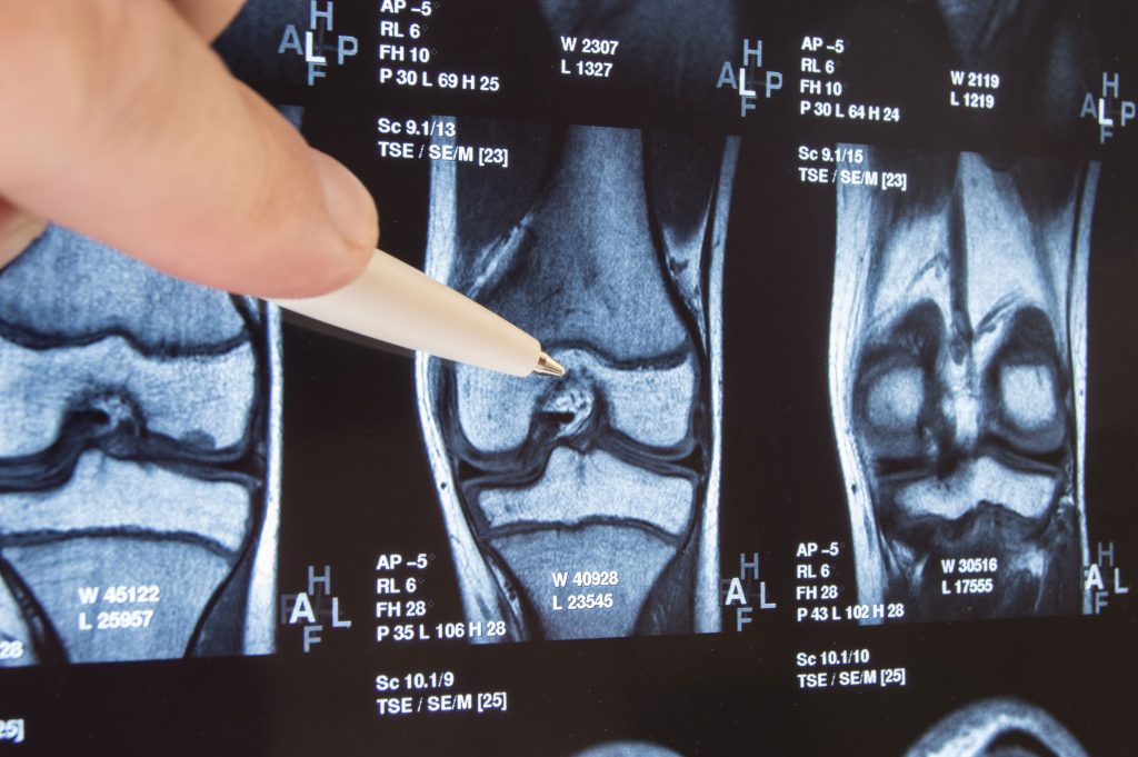 osteoarthritis shown in xray