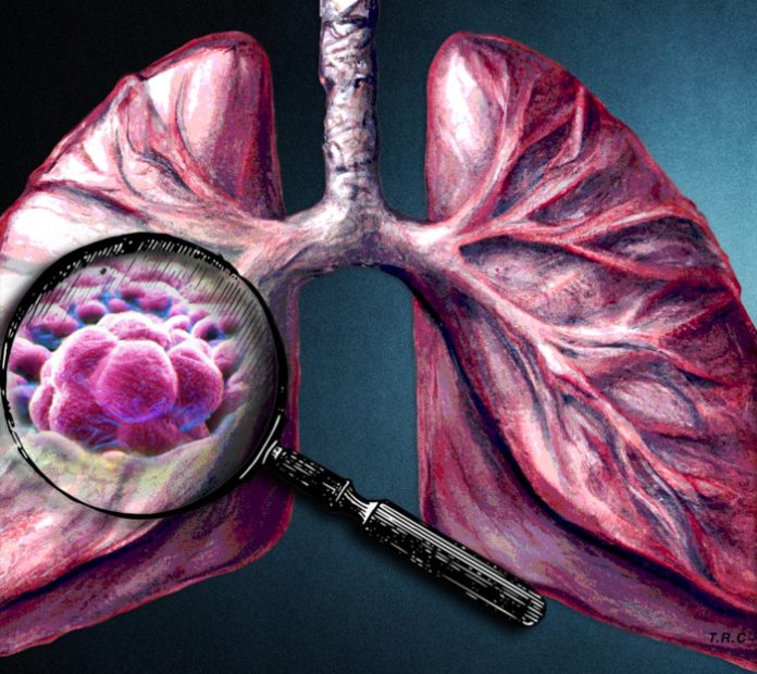 Lung Cancer Progression Predicted By Tumor Matrix