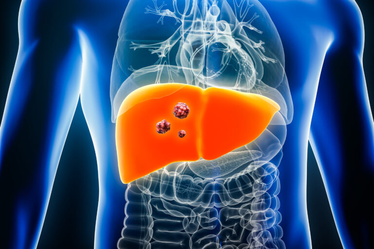 Liver Cancer Finding May Lead to New Class of Antitumor Therapies