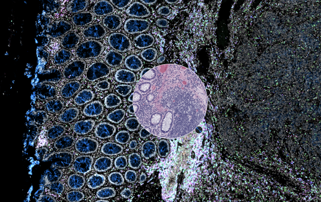 With Orion, pathologists can identify an area of interest on a tumor sample based on molecular details from immunofluorescence imaging, and overlay structural information using a “lens” of histology staining (circle).