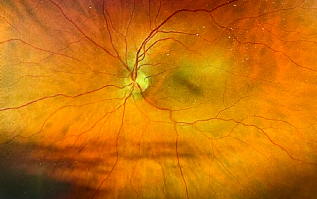 An image of a human retina taken during an eye exam