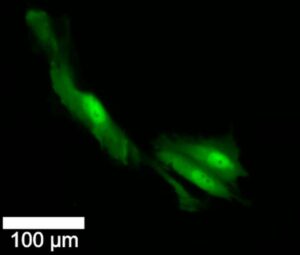 Fluorescent images of brain cancer cells that have survived chemotherapy and radiotherapy and have divided. There was one cell before treatment and three cells after treatment.