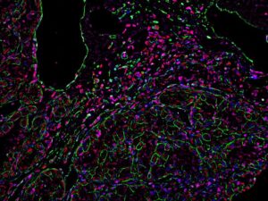 Immunofluorescence image shows macrophages (red) in human clear cell renal cell carcinoma, the most common type of kidney cancer in adults.