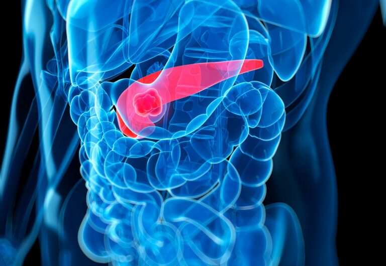 Pancreatic Cancer Could Be Detected Sooner with Nanoprobe-Based Blood Test