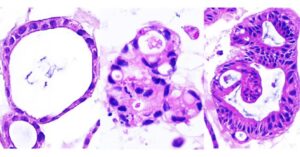 Histology images of patient-derived organoids: healthy (left), Crohn’s disease SF2CD subtype (middle) and Crohn's disease IDICD (right). [Image courtesy of Pradipta Ghosh. UC San Diego Health Sciences]