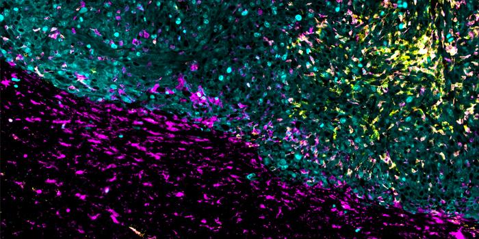 Novel Immunotherapy Attacks Glioblastoma from Multiple Angles