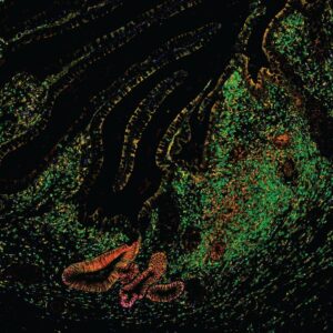 Imaging of human intestinal tissue in inflammatory bowel disease showing the presence of metaplastic epithelial glands. [A. Oliver, N. Huang, R. Li, et al. (2024)]