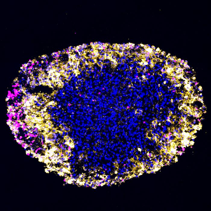 Patient Glioblastoma Response to CAR-T Cell Therapy Mirrored in Tumor-Derived Organoids in Real Time