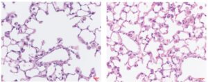 Prolonged exposure to cigarette smoke destroys the air sacs in mouse lungs (left). But this destruction is prevented in mice lacking MAIT cells (right). [© 2025 Awad et al. Originally published in Journal of Experimental Medicine.]